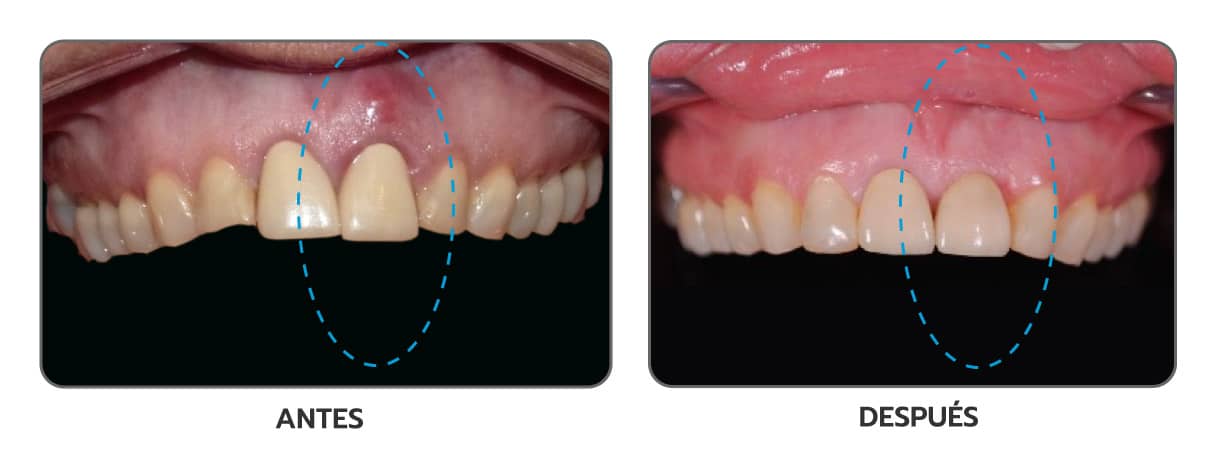 Comparación de antes y después de un implante unitario incisivo en Clínica Dental Augusto Leguía