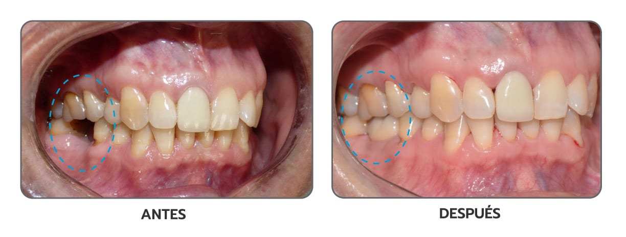 Antes y después de un implante unitario molar en Clínica Dental Augusto Leguía
