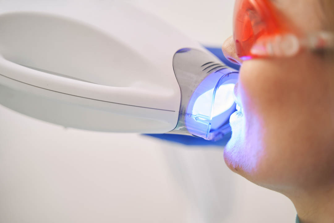 Mujer recibiendo tratamiento de blanqueamiento dental con láser en Clínica Dental Augusto Leguía